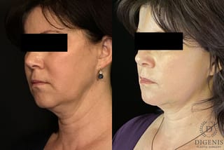 Before and after Digenis Refresh Lift case 35096 - Angle 4