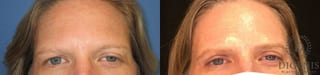 Before and after Eye Lid Surgery case 35097 - Angle 1