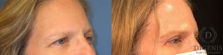 Before and after Eye Lid Surgery case 35097 - Angle 2
