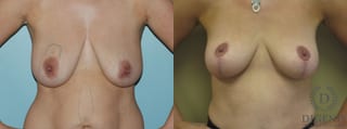 Before and after Breast Lift with or without Implants case 35098 - Angle 1