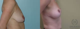 Before and after Breast Lift with or without Implants case 35098 - Angle 2