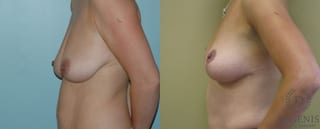 Before and after Breast Lift with or without Implants case 35098 - Angle 3