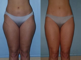 Before and after Liposuction case 35099 - Angle 1