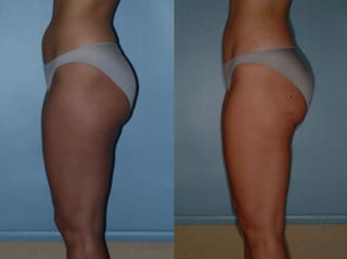 Before and after Liposuction case 35099 - Angle 4