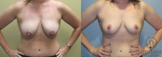 Before and after Breast Lift with or without Implants case 35100 - Angle 1