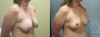 Before and after Breast Lift with or without Implants case 35100 - Angle 2