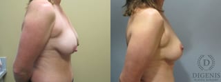Before and after Breast Lift with or without Implants case 35100 - Angle 3