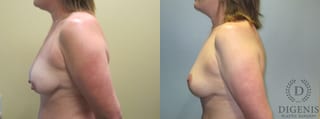 Before and after Breast Lift with or without Implants case 35100 - Angle 5