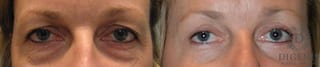 Before and after Eye Lid Surgery case 35101 - Angle 1