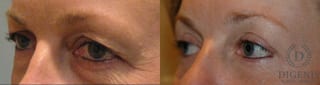 Before and after Eye Lid Surgery case 35101 - Angle 3