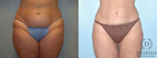 Before and after Liposuction case 35102 - Angle 1