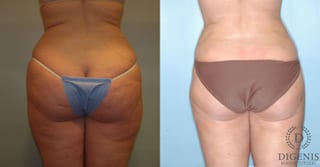 Before and after Liposuction case 35102 - Angle 2