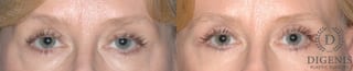 Before and after Eye Lid Surgery case 35104 - Angle 1