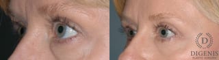 Before and after Eye Lid Surgery case 35104 - Angle 3