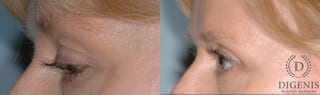 Before and after Eye Lid Surgery case 35104 - Angle 4