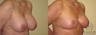 Before and after Breast Lift with or without Implants case 35105 - Angle 2