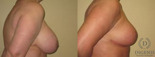 Before and after Breast Lift with or without Implants case 35105 - Angle 3