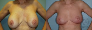 Before and after Breast Lift with or without Implants case 35107 - Angle 1