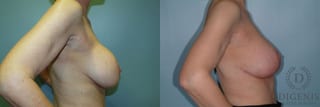 Before and after Breast Lift with or without Implants case 35107 - Angle 3