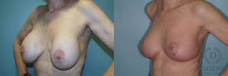 Before and after Breast Lift with or without Implants case 35107 - Angle 4