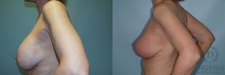 Before and after Breast Lift with or without Implants case 35107 - Angle 5