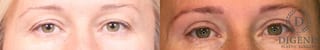 Before and after Eye Lid Surgery case 35108 - Angle 1