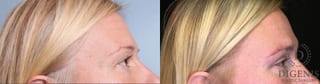 Before and after Eye Lid Surgery case 35108 - Angle 2