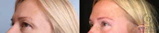 Before and after Eye Lid Surgery case 35108 - Angle 3