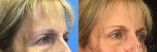 Before and after Eye Lid Surgery case 35109 - Angle 2
