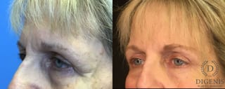 Before and after Eye Lid Surgery case 35109 - Angle 4