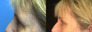 Before and after Eye Lid Surgery case 35109 - Angle 5