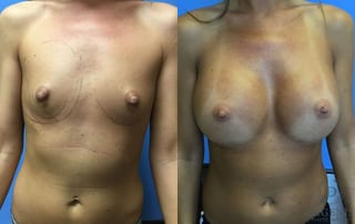 Before and after Breast Augmentation case 35110 - Angle 1