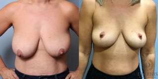 Before and after Breast Lift with or without Implants case 35111 - Angle 1