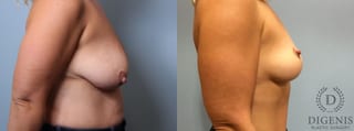 Before and after Breast Lift with or without Implants case 35111 - Angle 3