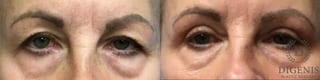 Before and after Eye Lid Surgery case 35112 - Angle 1