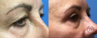 Before and after Eye Lid Surgery case 35112 - Angle 2