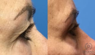 Before and after Eye Lid Surgery case 35112 - Angle 3