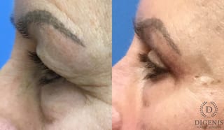 Before and after Eye Lid Surgery case 35112 - Angle 5