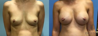Before and after Breast Augmentation case 35113 - Angle 1