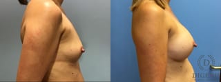 Before and after Breast Augmentation case 35113 - Angle 3