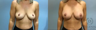 Before and after Breast Augmentation case 35114 - Angle 1