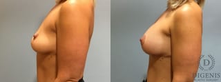 Before and after Breast Augmentation case 35114 - Angle 5