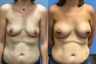 Before and after Breast Augmentation case 35115 - Angle 1