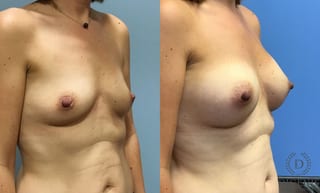 Before and after Breast Augmentation case 35115 - Angle 2