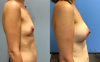 Before and after Breast Augmentation case 35115 - Angle 3