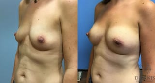 Before and after Breast Augmentation case 35115 - Angle 4