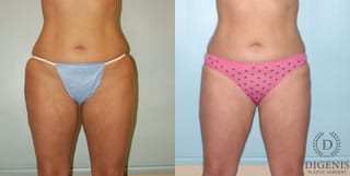 Before and after Liposuction case 35124 - Angle 1