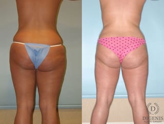 Before and after Liposuction case 35124 - Angle 2