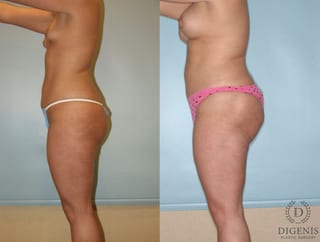 Before and after Liposuction case 35124 - Angle 4