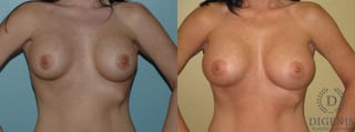 Before and after Breast Implant Exchange or Removal case 35125 - Angle 1
